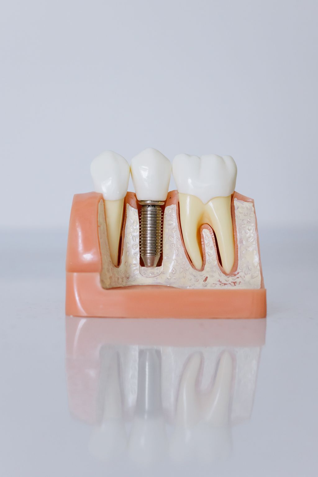 ¿Perdiste varios dientes? No siempre necesitas un implante por cada uno